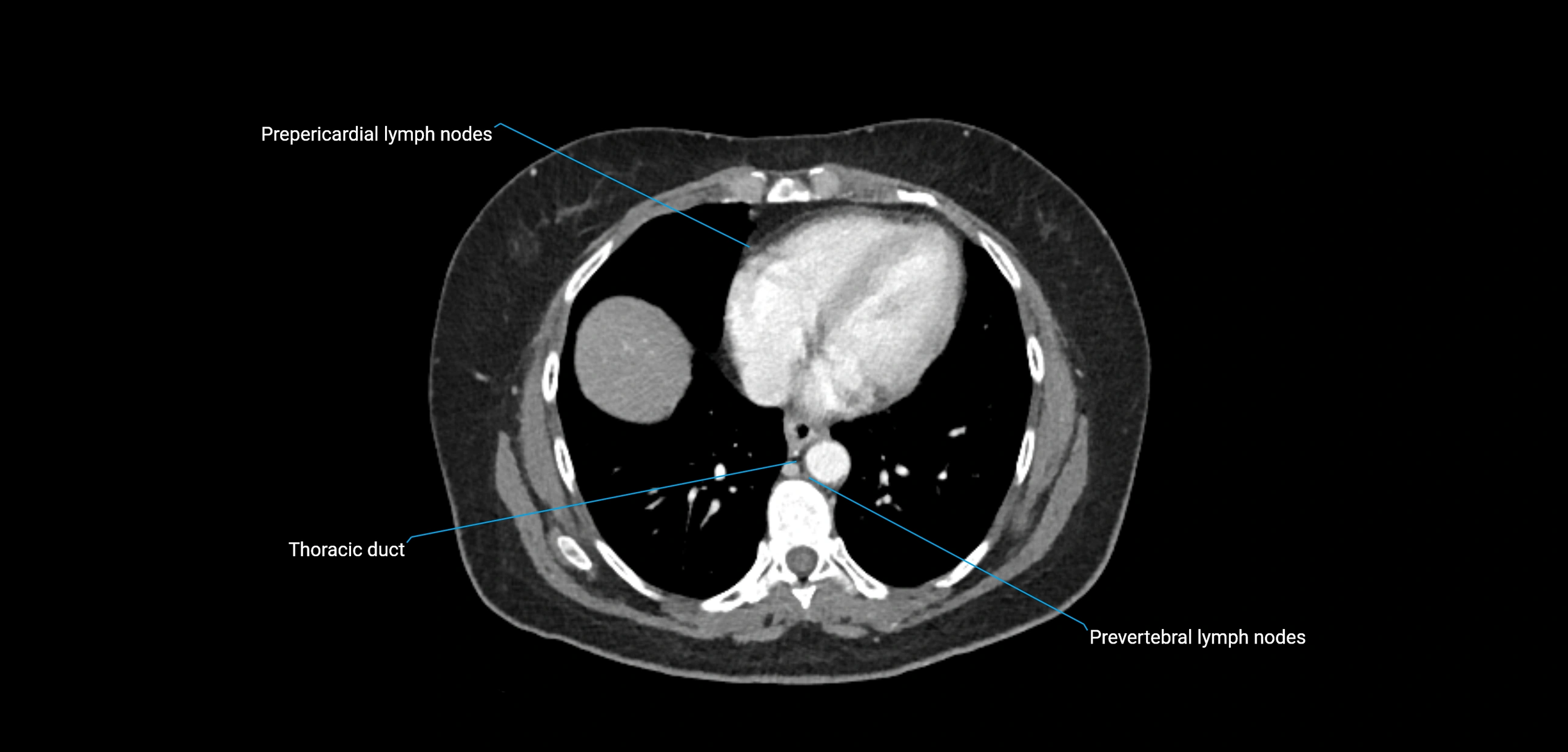 CT ct abdominal lymph nodes  axial cross sectional anatomy  enchanced radiology image -img-00002-00051.webp